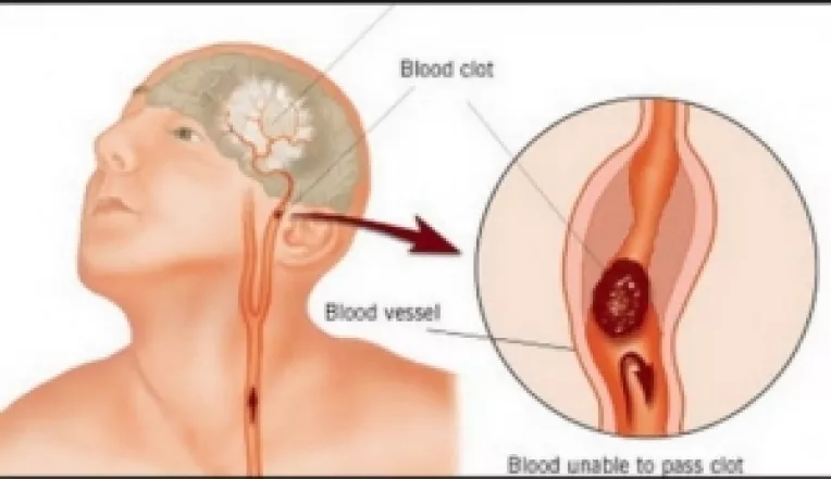 Efectele unui accident vascular cerebral pot fi nedetectabile daca tesutul degradat nu indeplineste o functie critica