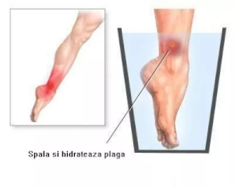 Stildeviata : Tetanosul – Ce este si cum se trateaza (1)